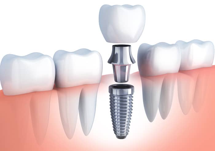 Types and Procedures of Dental implants