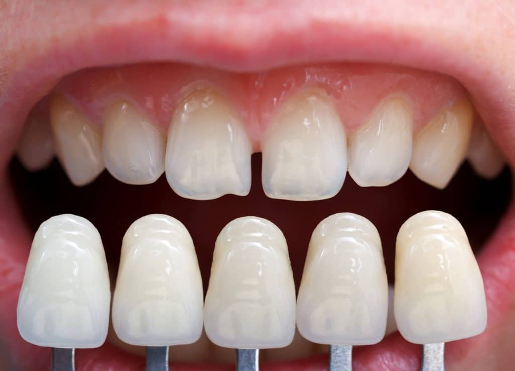 How to improve teeth with veneers odessa fl?
