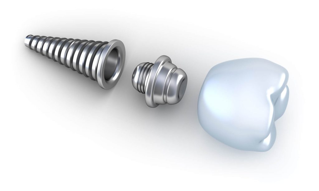 who offers the best implant restoration odessa fl?