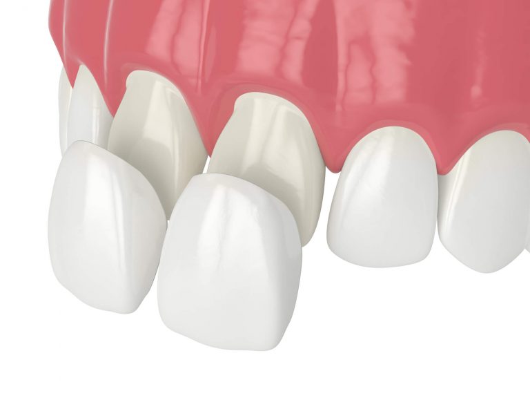 Habits that Can Damage Your Veneers Spring Haven Dental