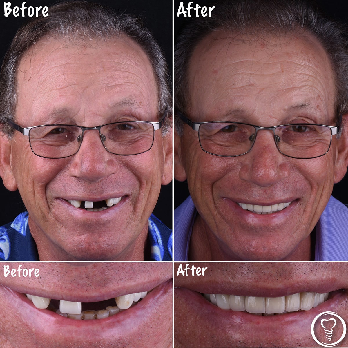 A mature guy learns how to get healthy gums and teeth.