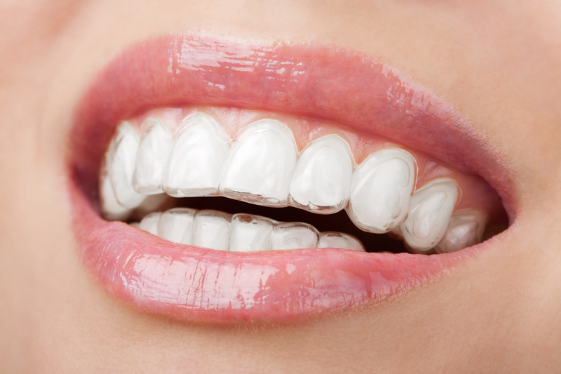 Invisalign: Your Path to a Stunning Smile in Odessa