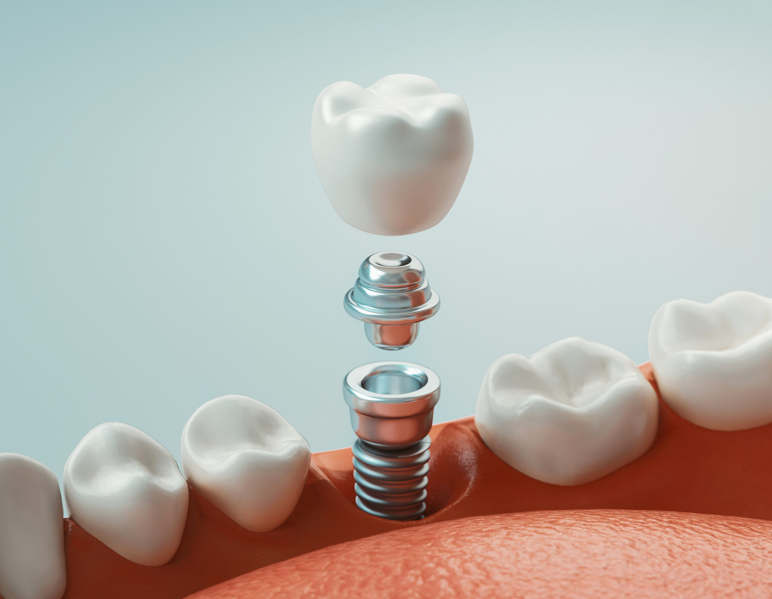 Dental Implants vs. Dentures: Choosing Your Smile