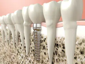 Rediscover Culinary Joy: Dental Implants for Foodies