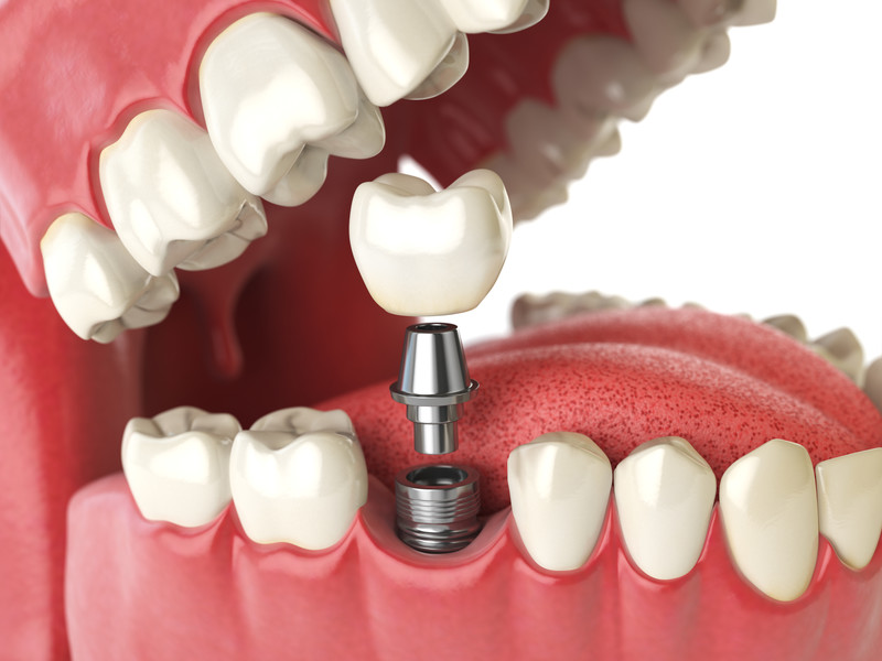 Navigating Dental Implants: Your Guide to a Perfect Smile