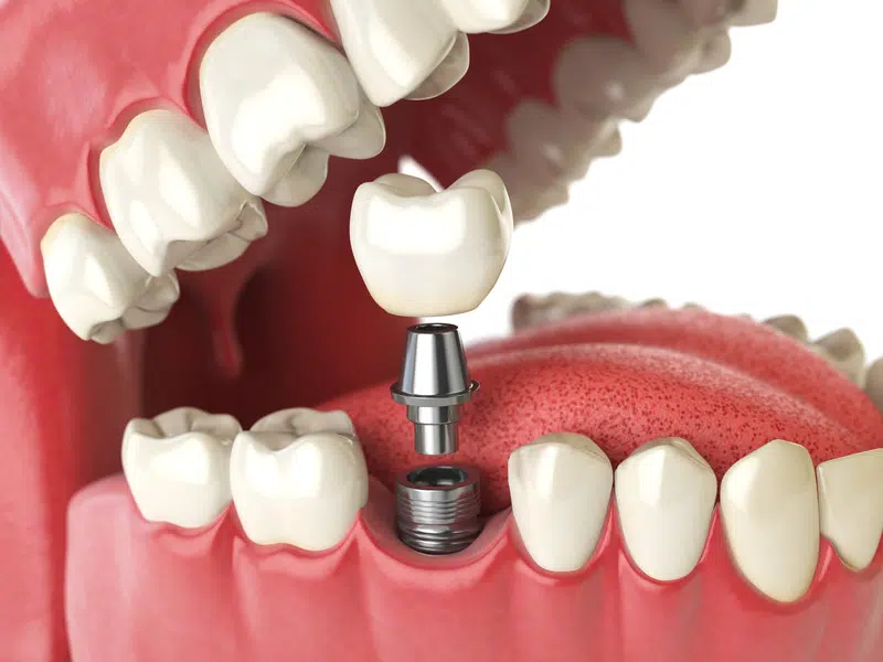 Navigating Dental Implants: Your Guide to a Perfect Smile