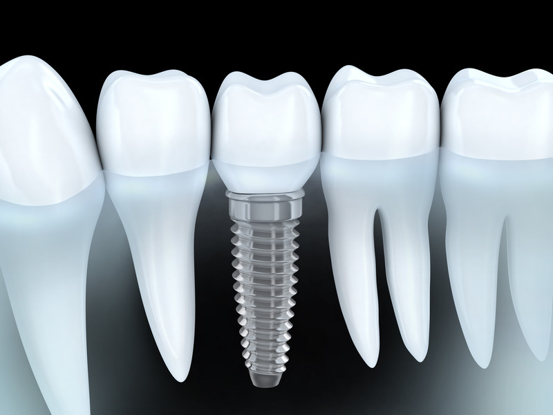 Dental Implants: Cavity-Free Tooth Replacement Option