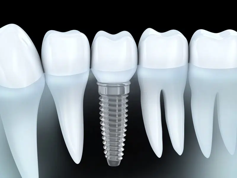 Dental Implants: Cavity-Free Tooth Replacement Option